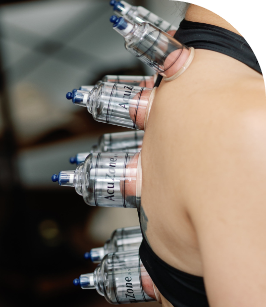 Cupping therapy on person's back