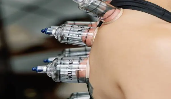 Cupping therapy on person's back